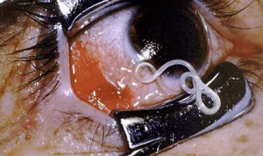 Rodzaje pasożytów w ludzkim ciele